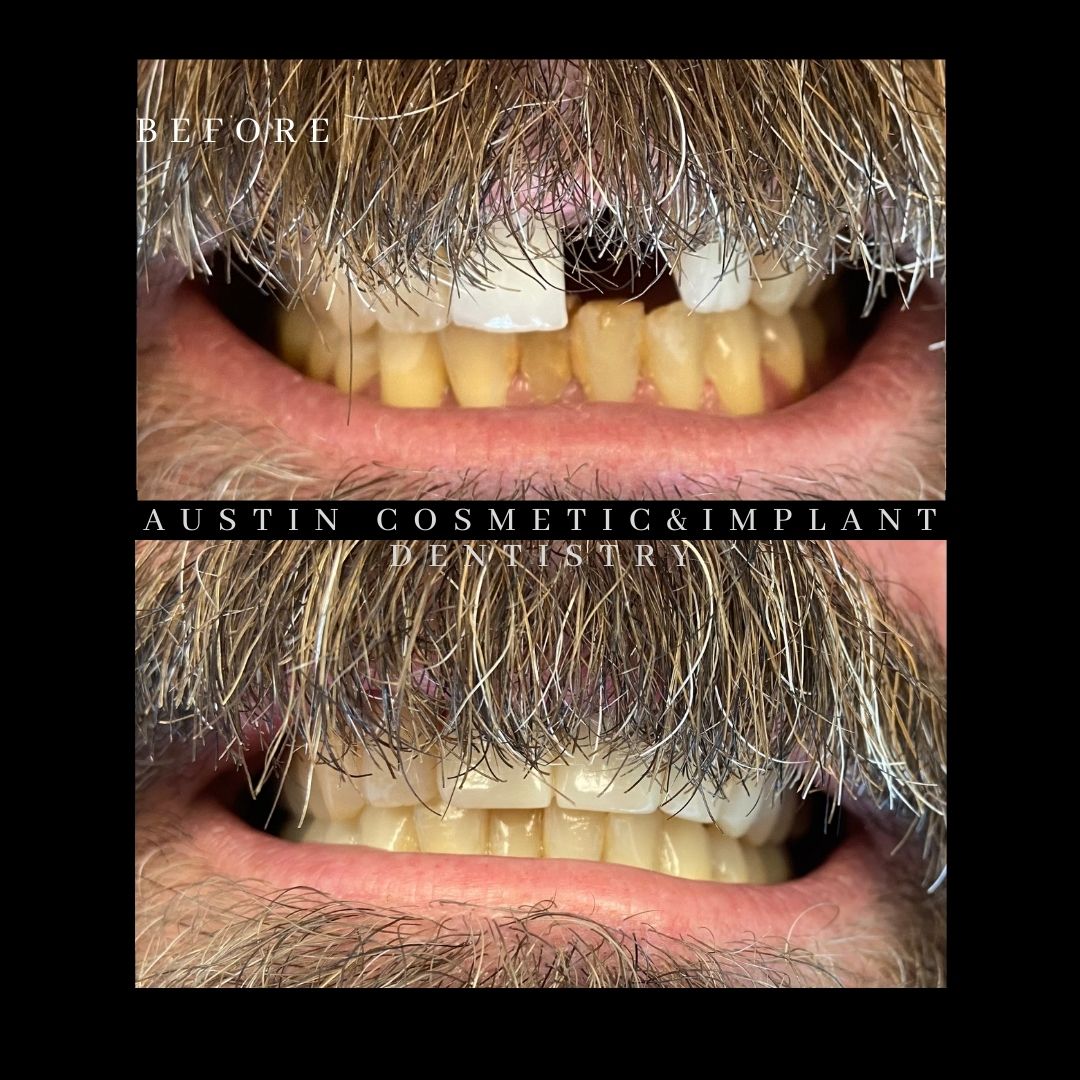Dental implant revision in Austin, TX