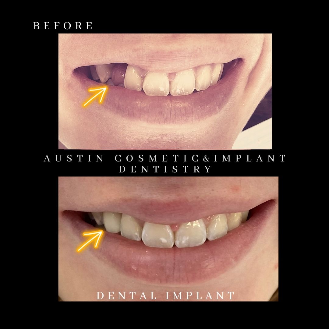 Same day dental implants in Austin, TX