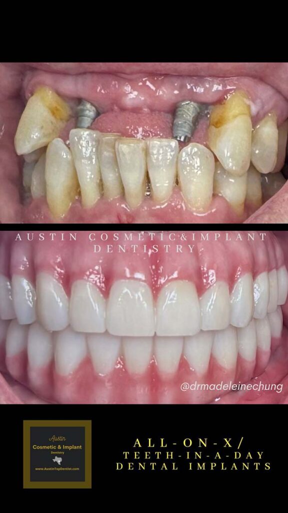 Transitional-Prostheses